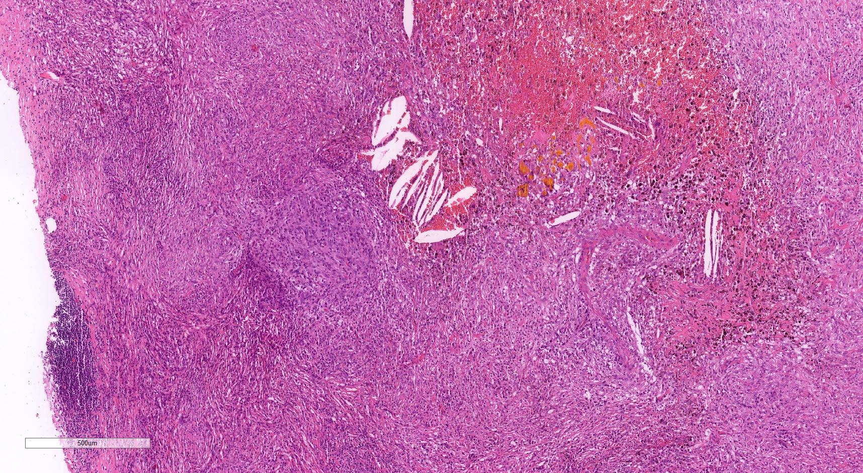 Angiomatoid fibrous histiocytoma area