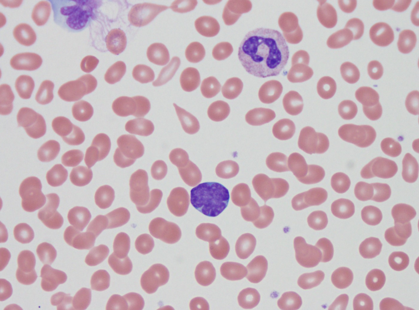 T-lymphoblast on blood smear 