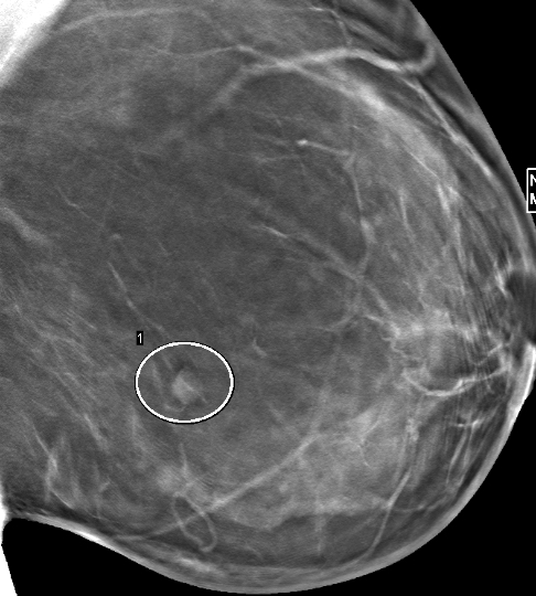 Screening mammography