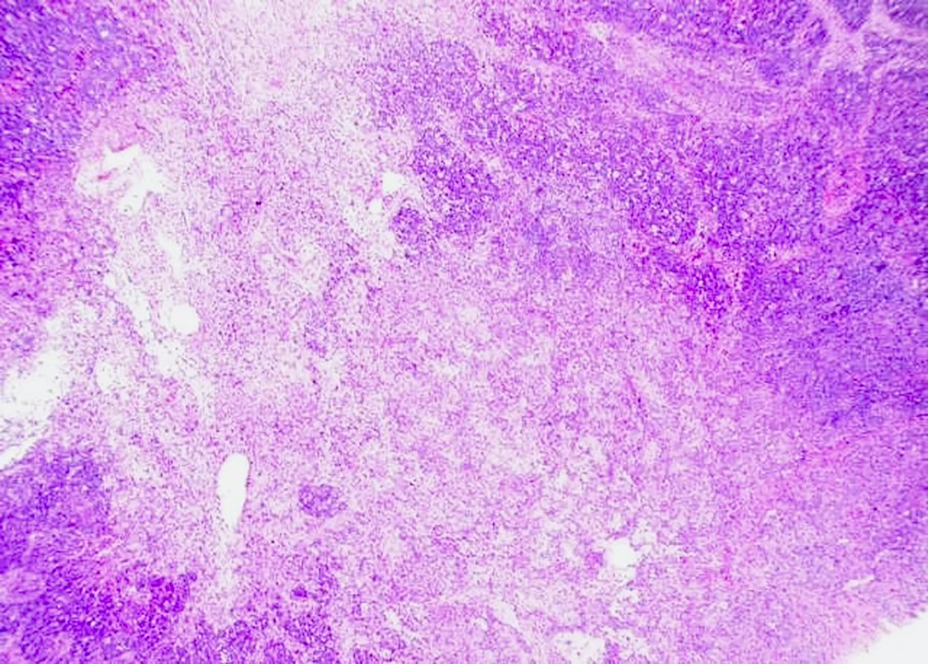 Kaposi sarcoma in a case of HHV8 MCD
