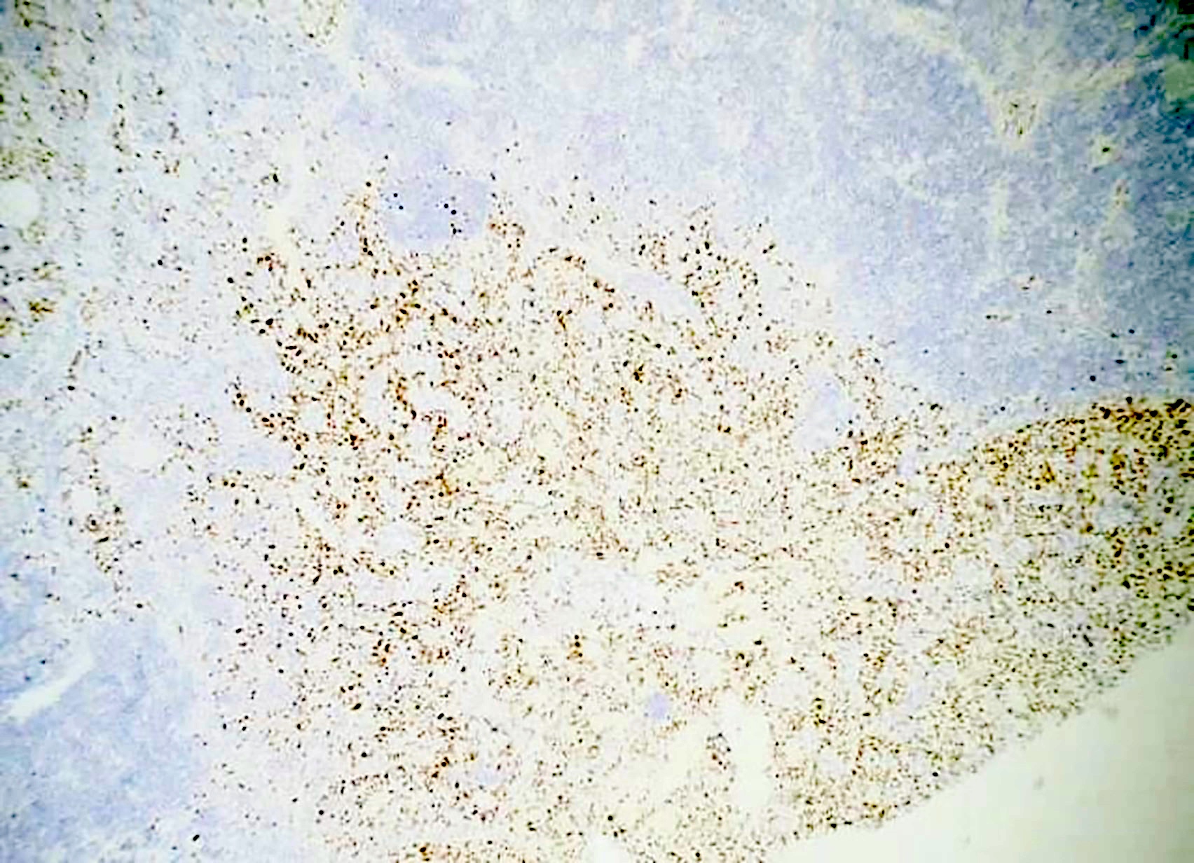 Kaposi sarcoma in a case of HHV8 MCD, HHV8