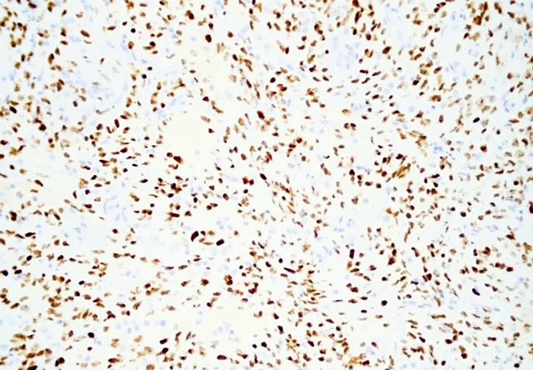 Kaposi sarcoma in a case of HHV8 MCD, HHV8