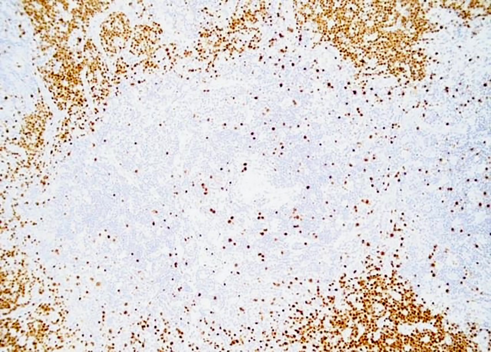 Kaposi sarcoma in a case of HHV8 MCD, MUM