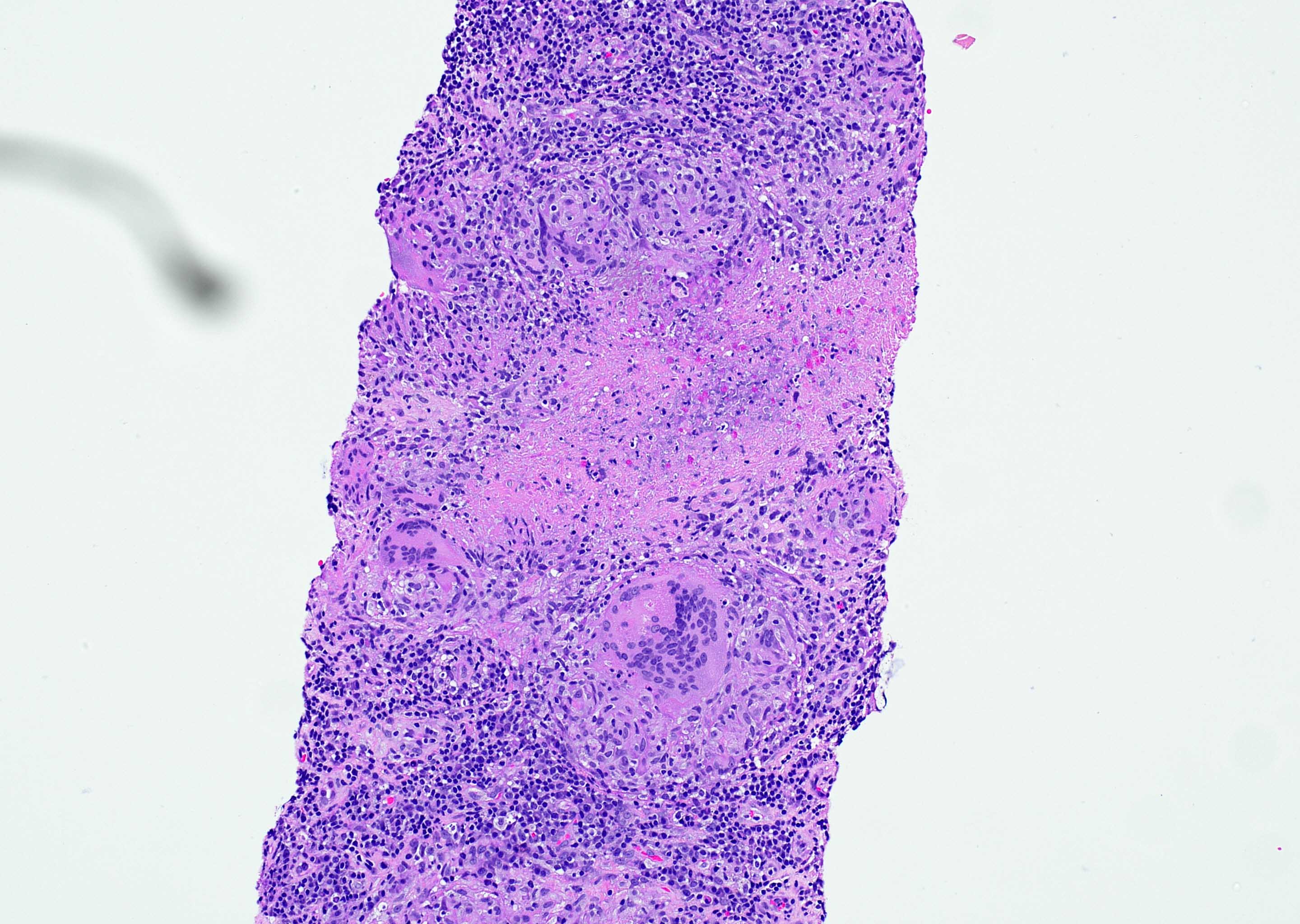 Necrotizing granuloma in a cervical lymph node