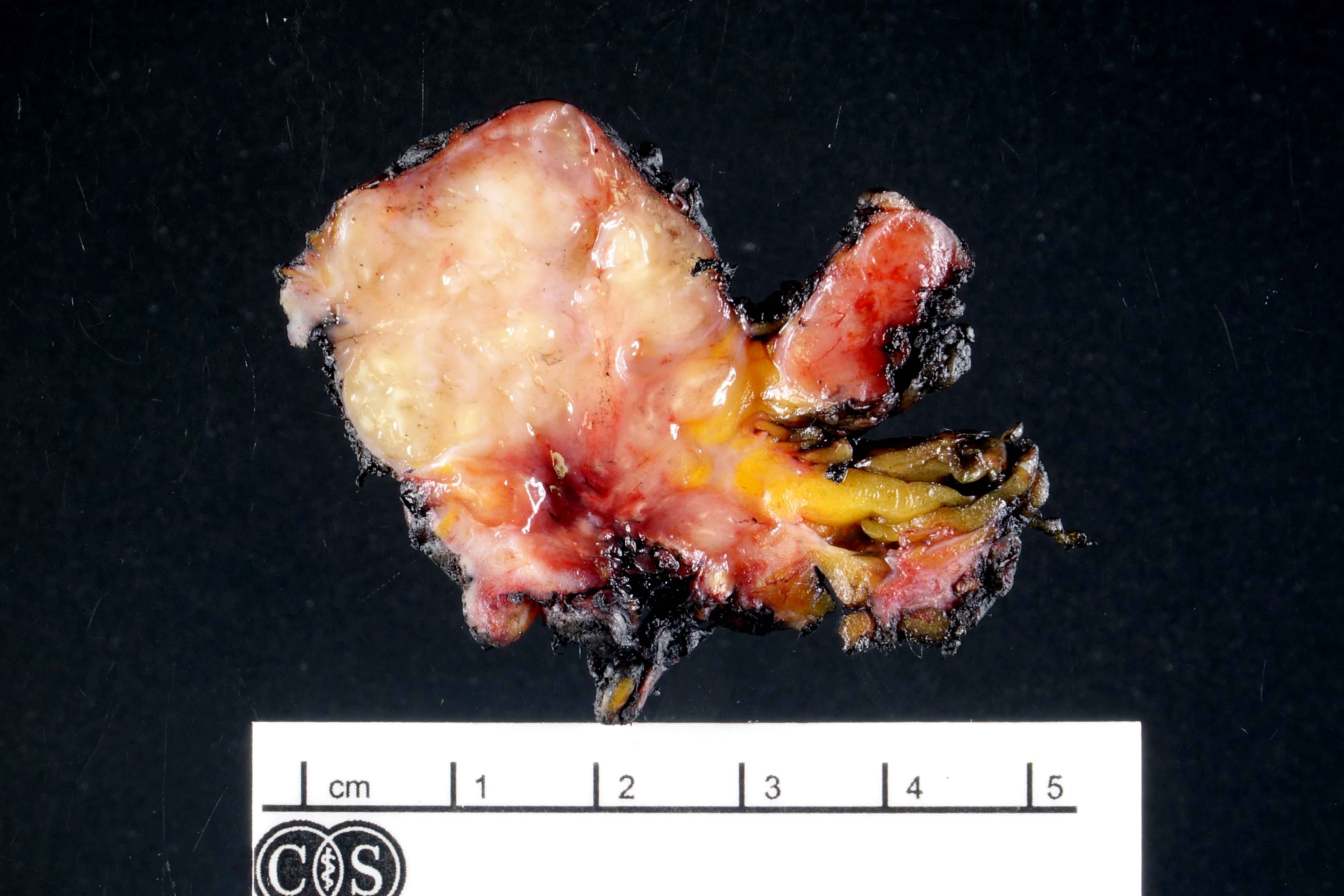 Inguinal lymph node with necrotizing granuloma