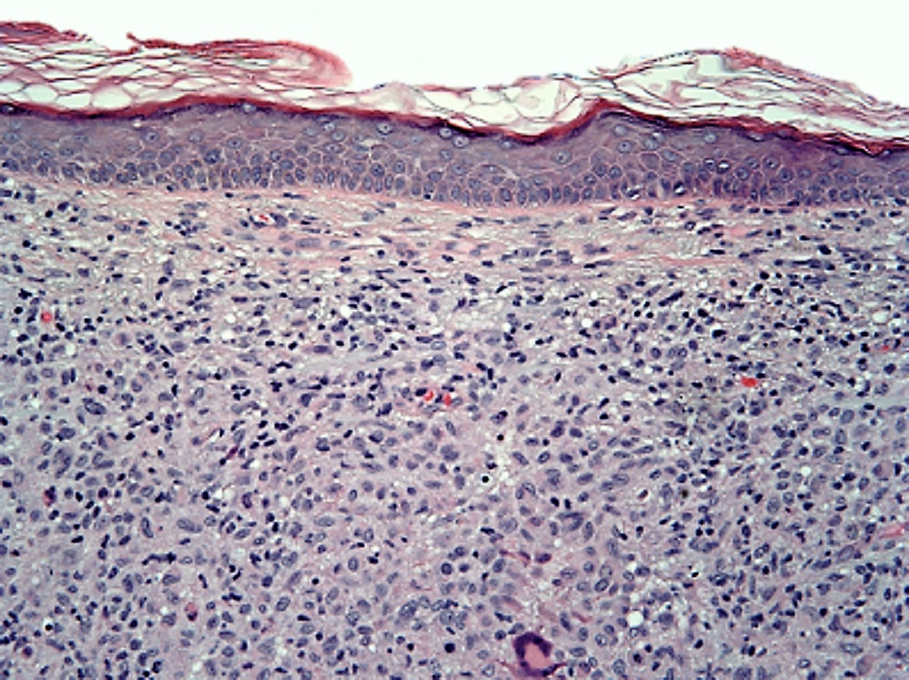 dermal histiocytoid cells