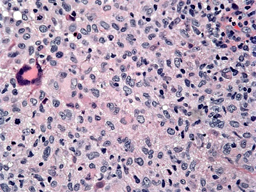 histiocytoid cells