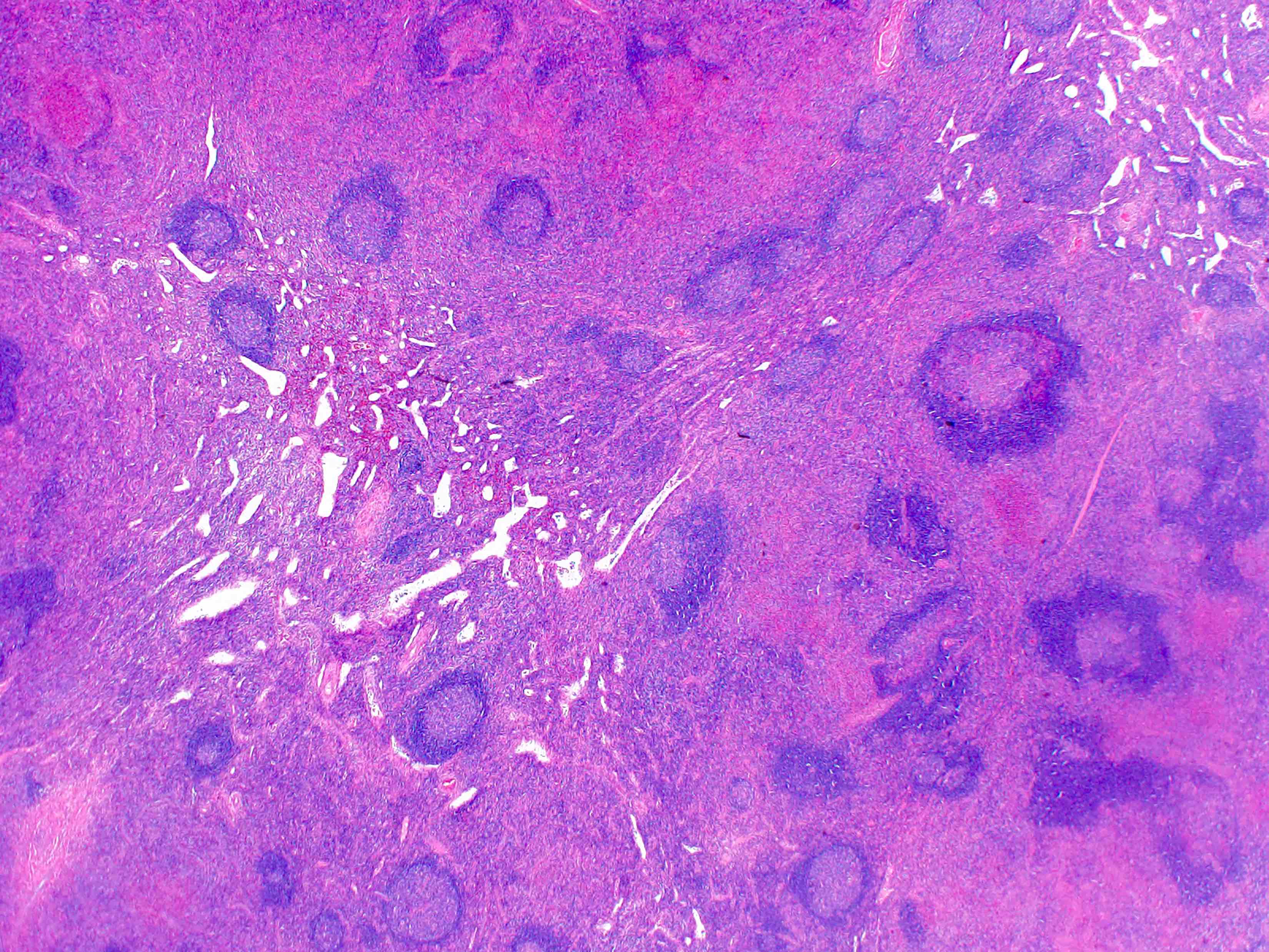 Excisional biopsy of lymph node