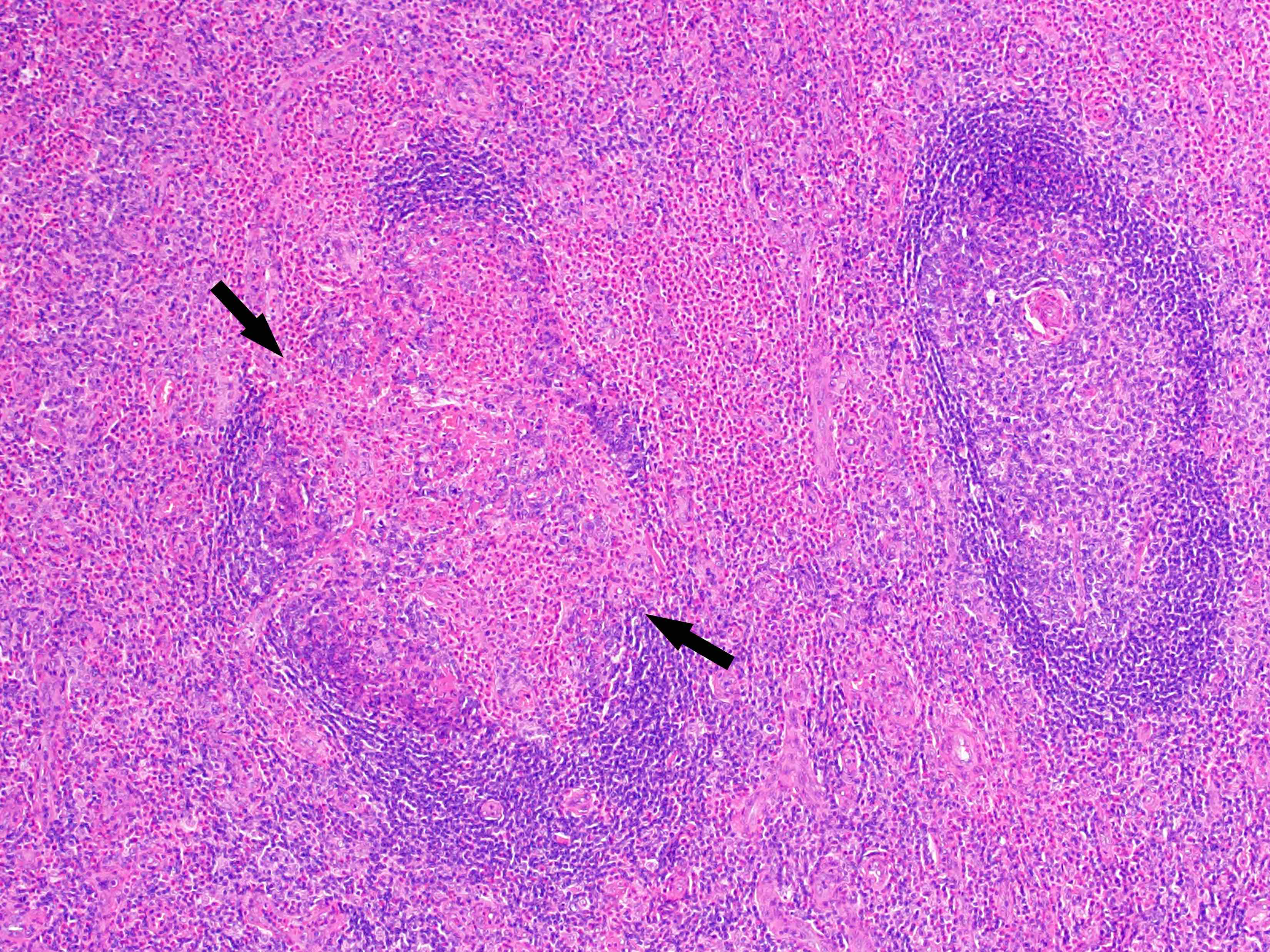 Excisional biopsy of lymph node
