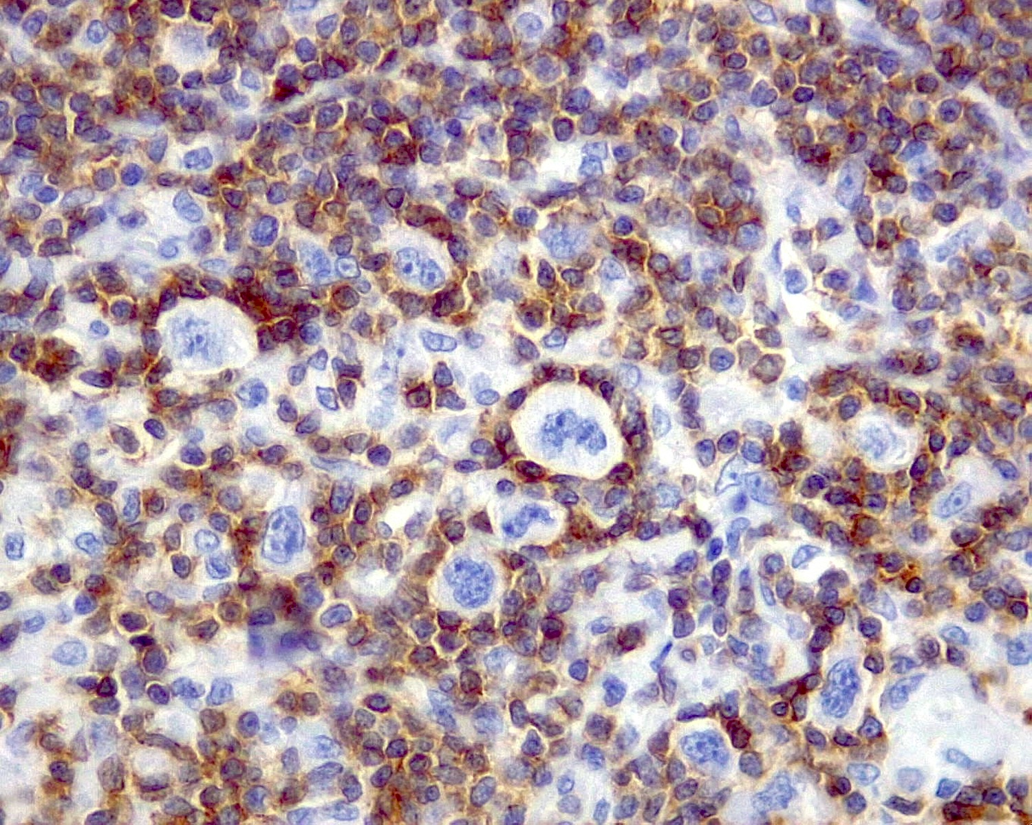 Rosetting CD3+ lymphocytes