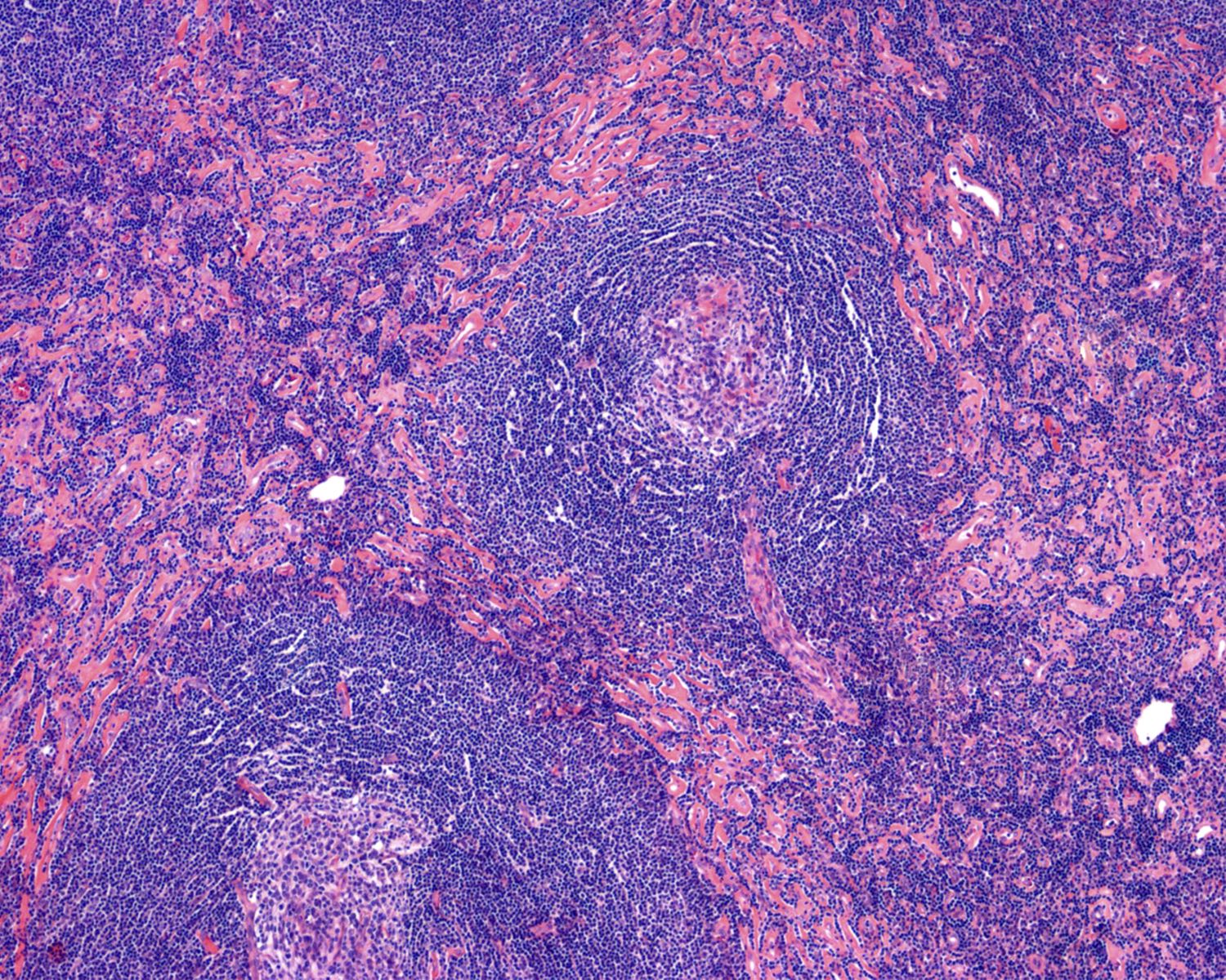 Castleman disease, hyaline vascular variant