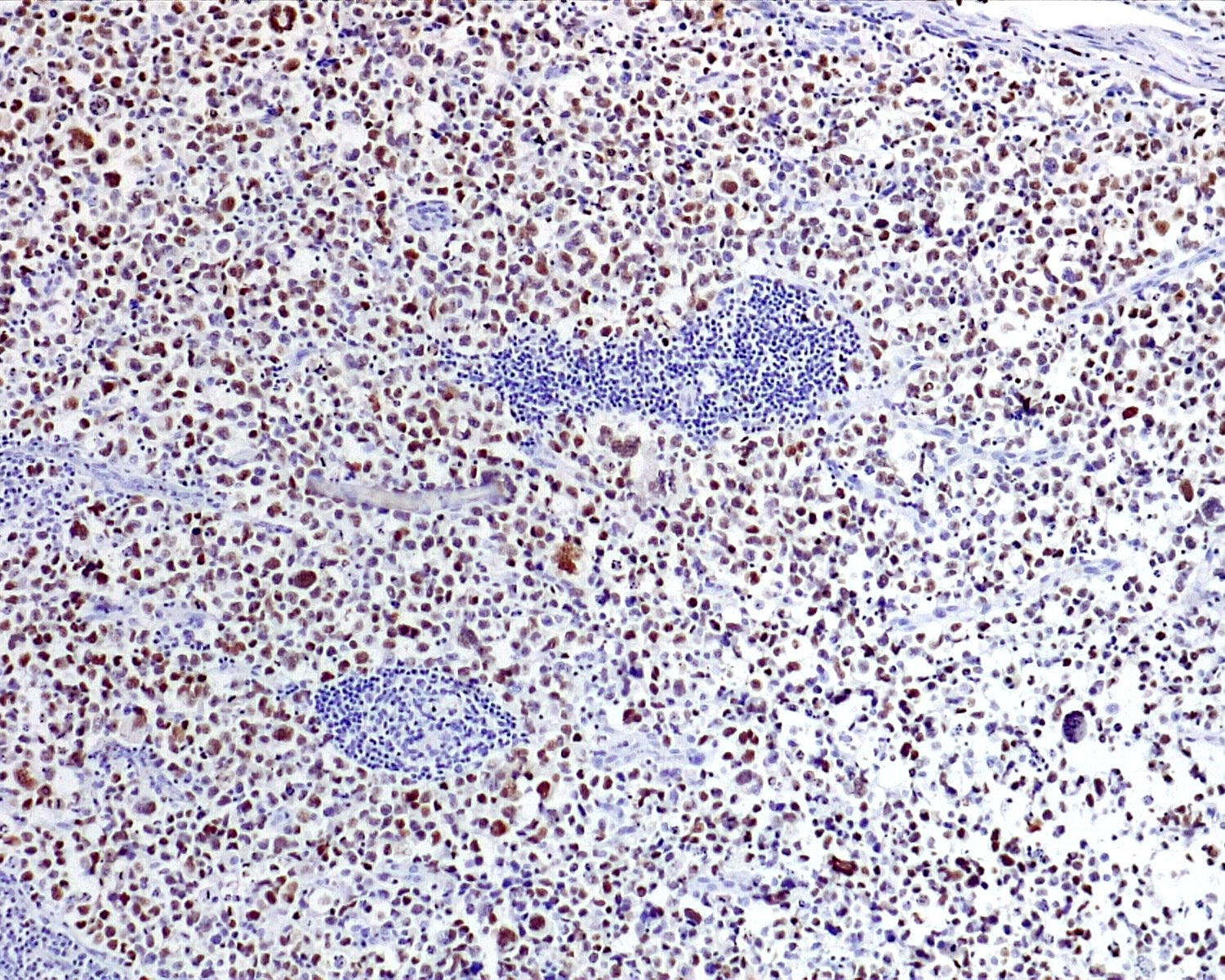 EBER positivity in EBV positive diffuse large B cell lymphoma