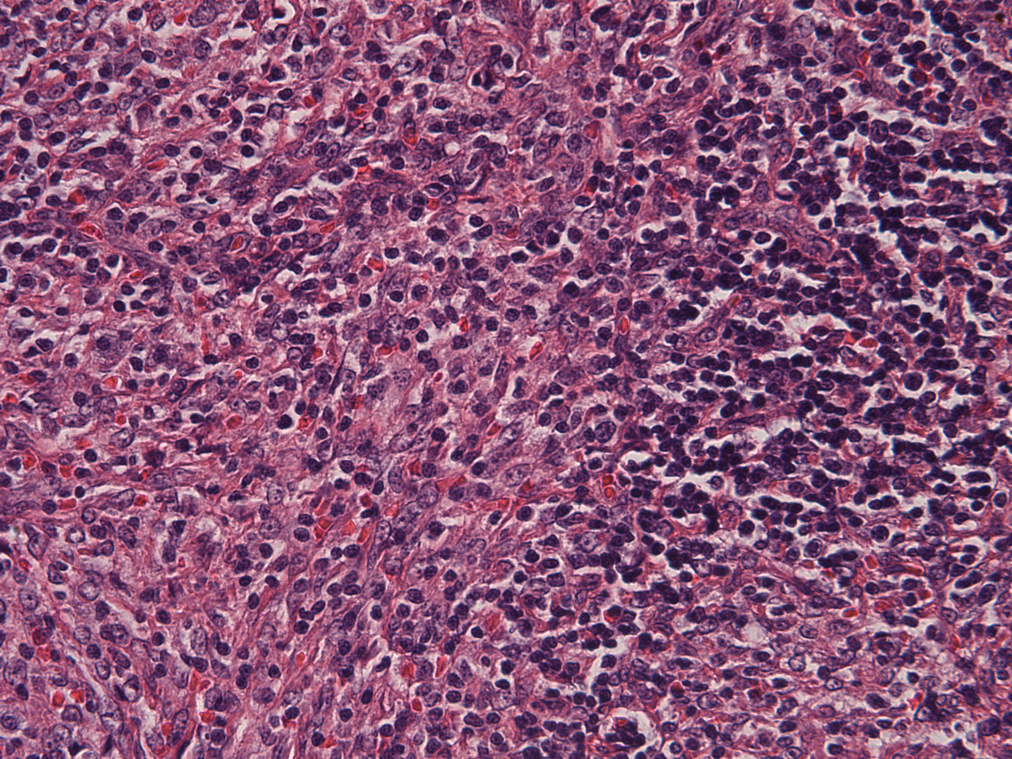 Follicular dendritic cell tumor