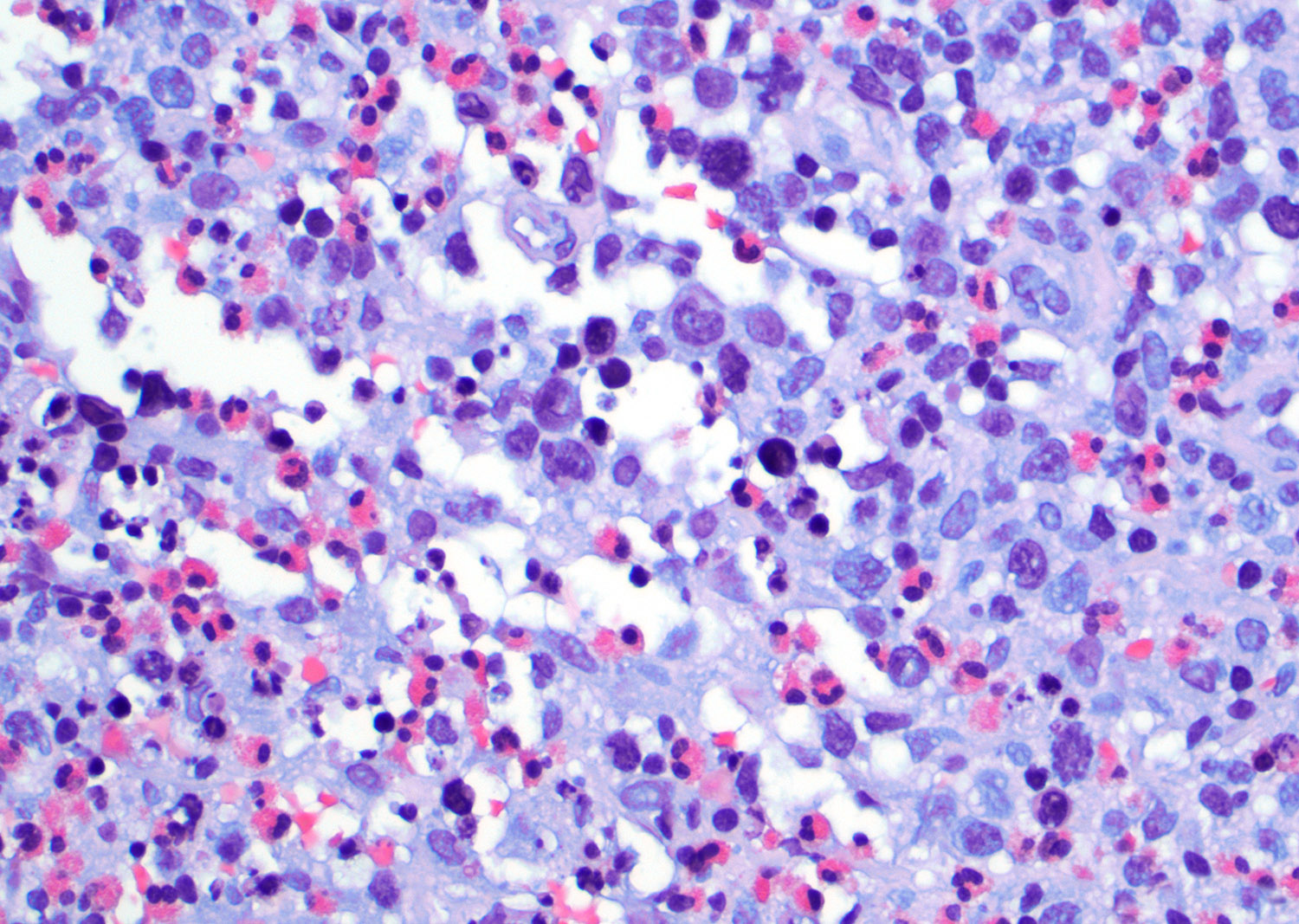 Polymorphic infiltrate with eosinophilia