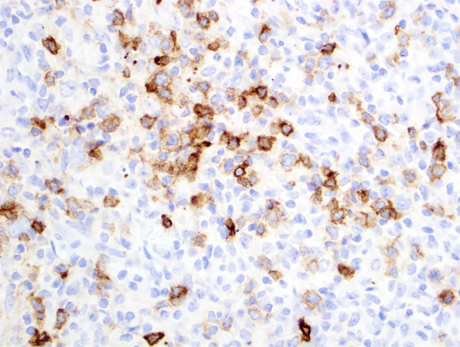 CD10 in small and intermediate size lymphoma cells