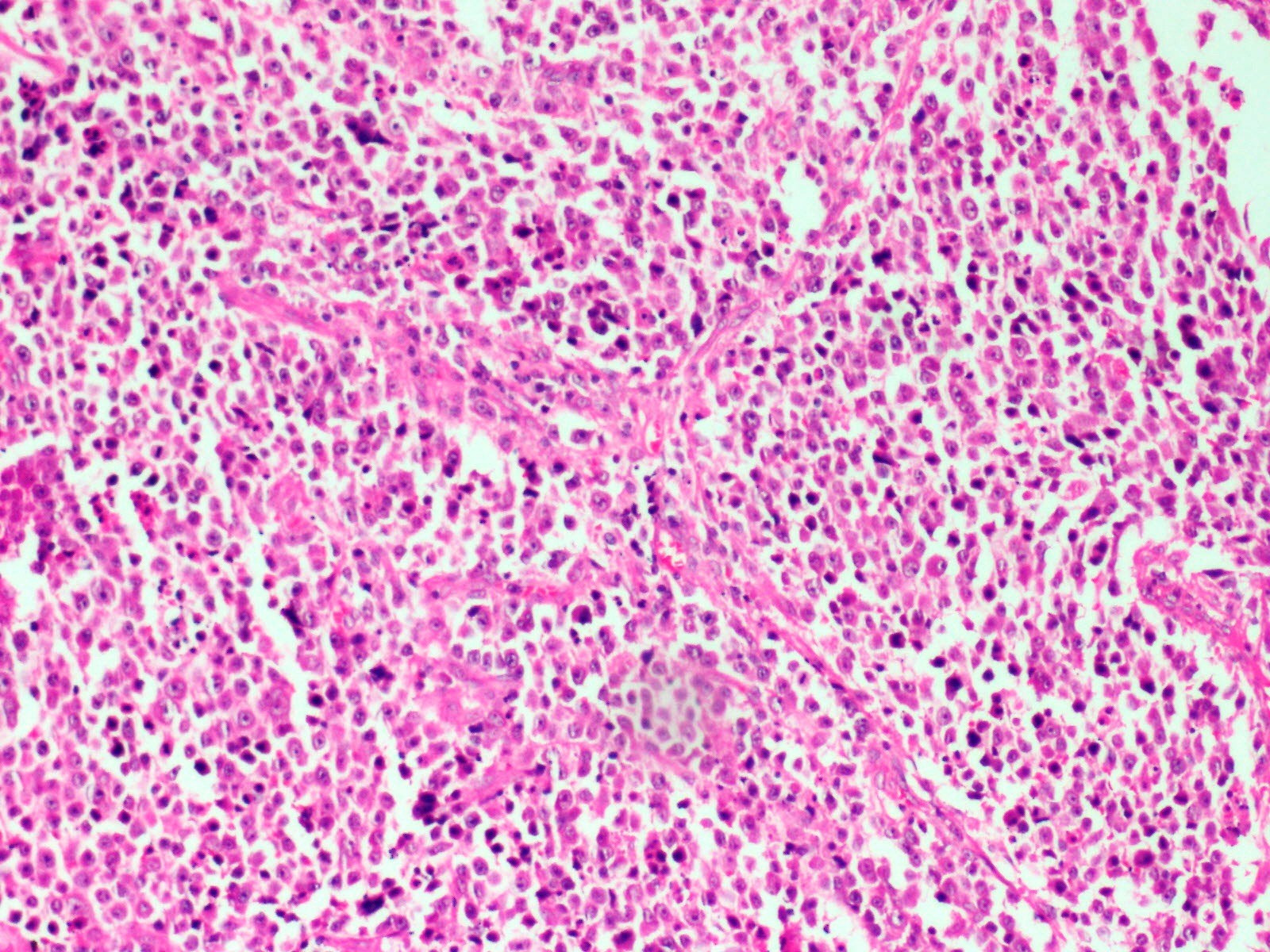 Large lymphoid tumor cells