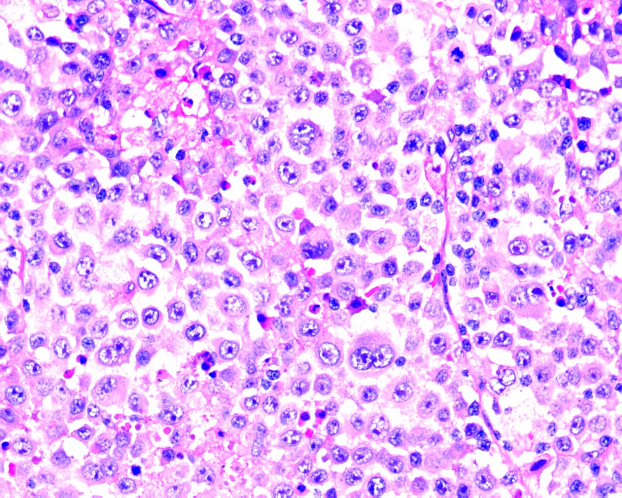 Immunoblast-like tumor cells and few plasmablasts