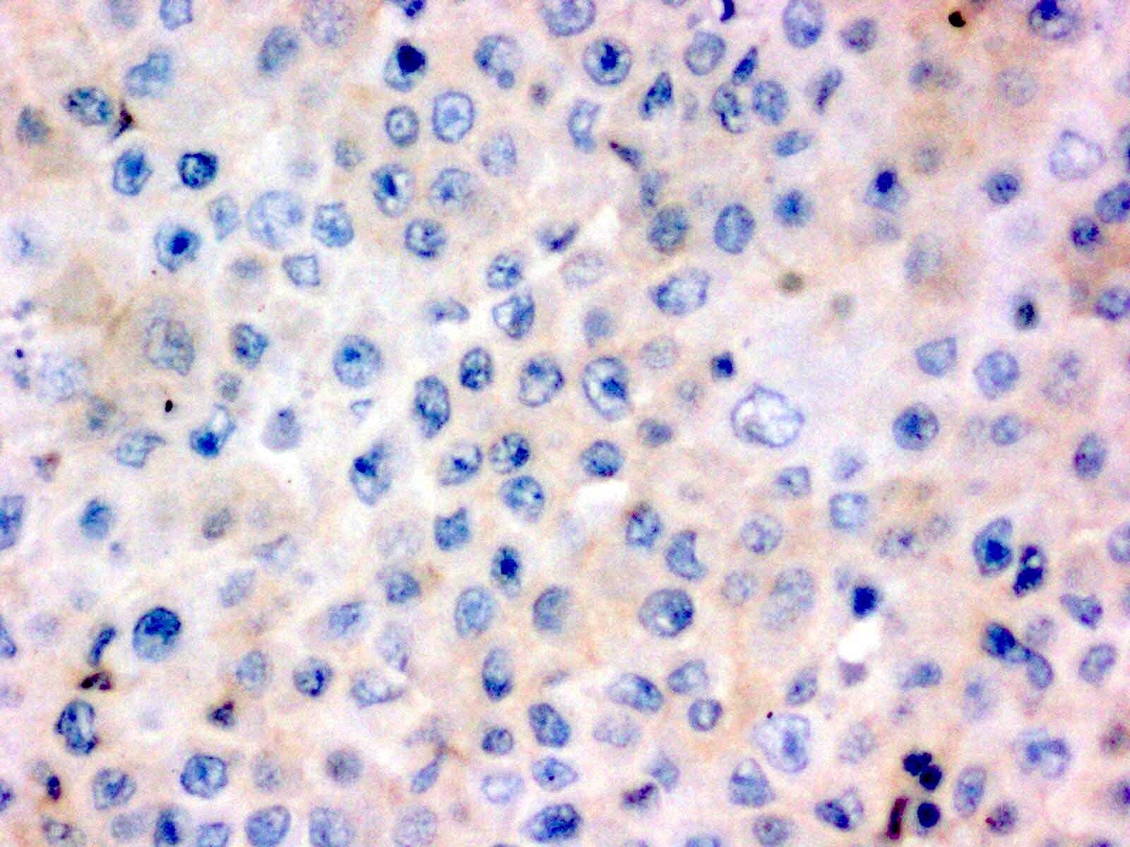 CD30 negativity in tumor cells