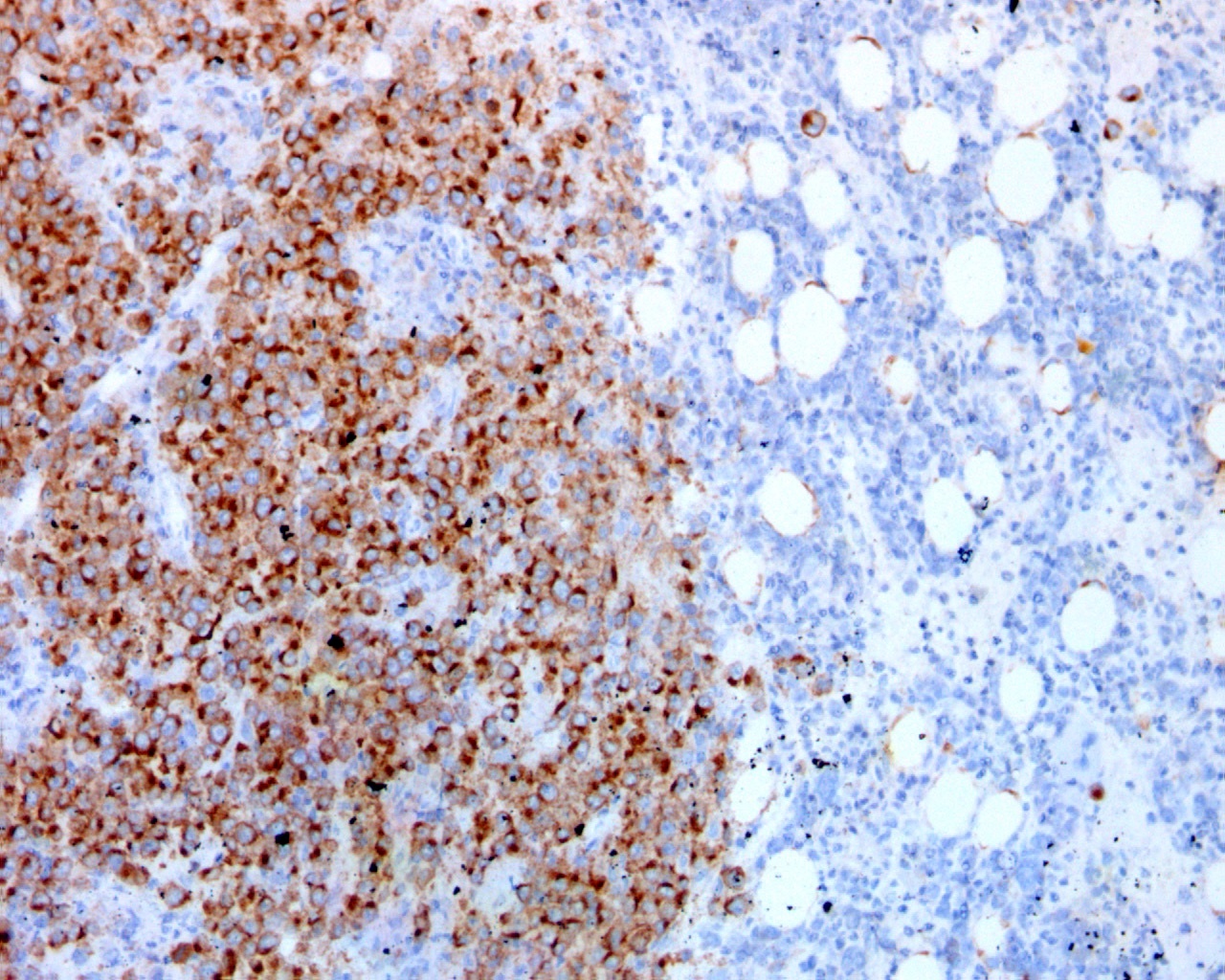 Granular ALK positivity in tumor cells