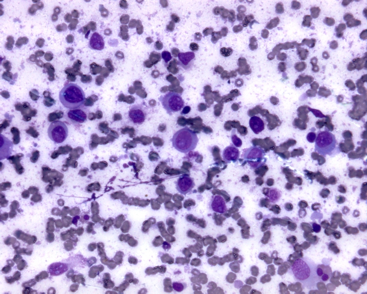 ALK positive large B cell lymphoma cells