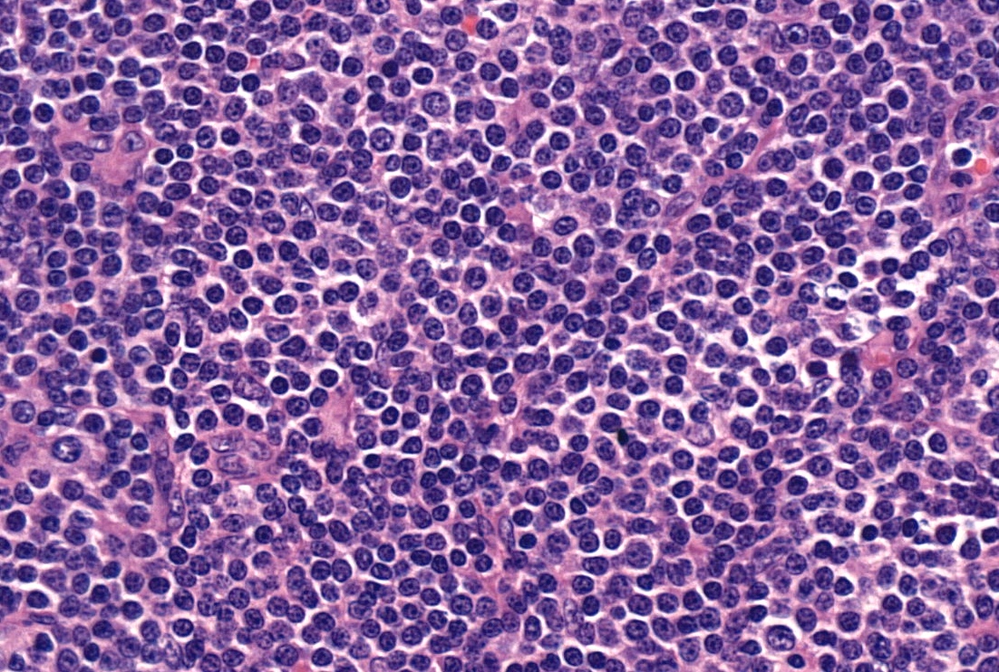 Diffuse lymphocytic infiltrate