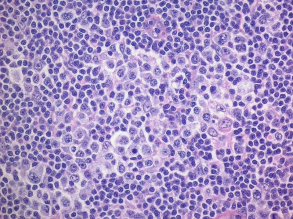 Atypical lymphoid aggregates