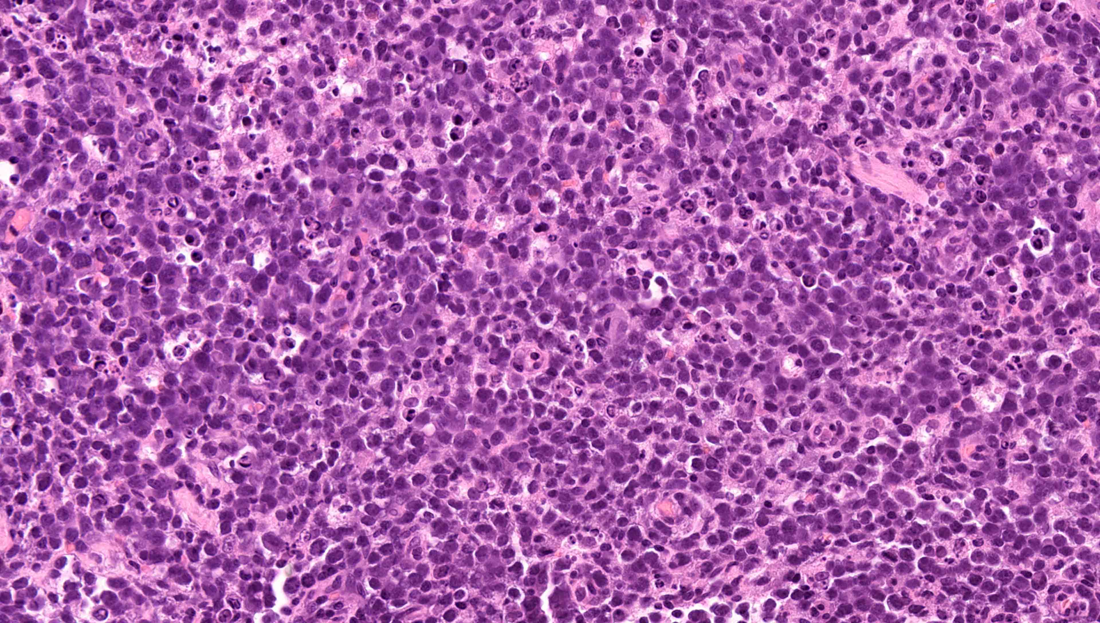 Atypical large lymphoid cells
