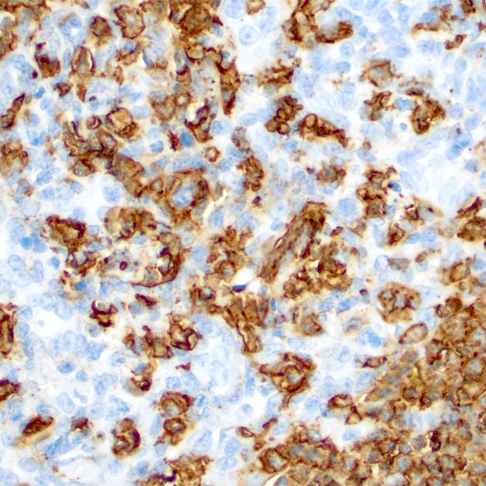 CD20 positivity in salivary gland lymphoepithelial lesion
