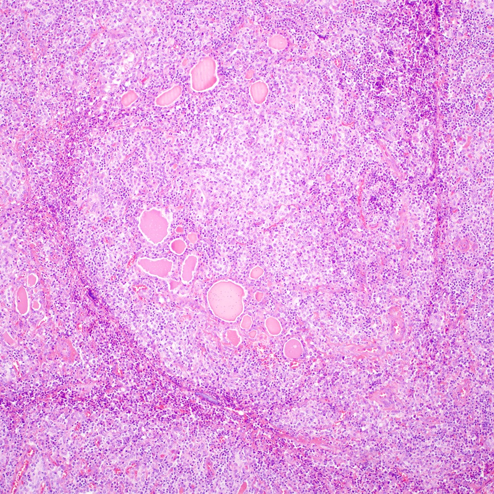 Thyroid gland MALT lymphoma