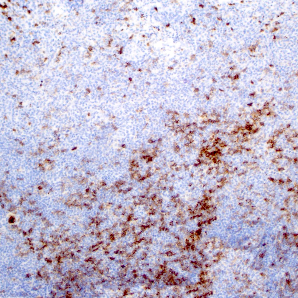 CD10 negativity in MALT lymphoma