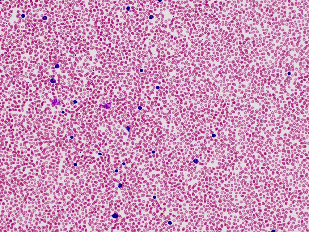 Atypical monotonous lymphocyte population