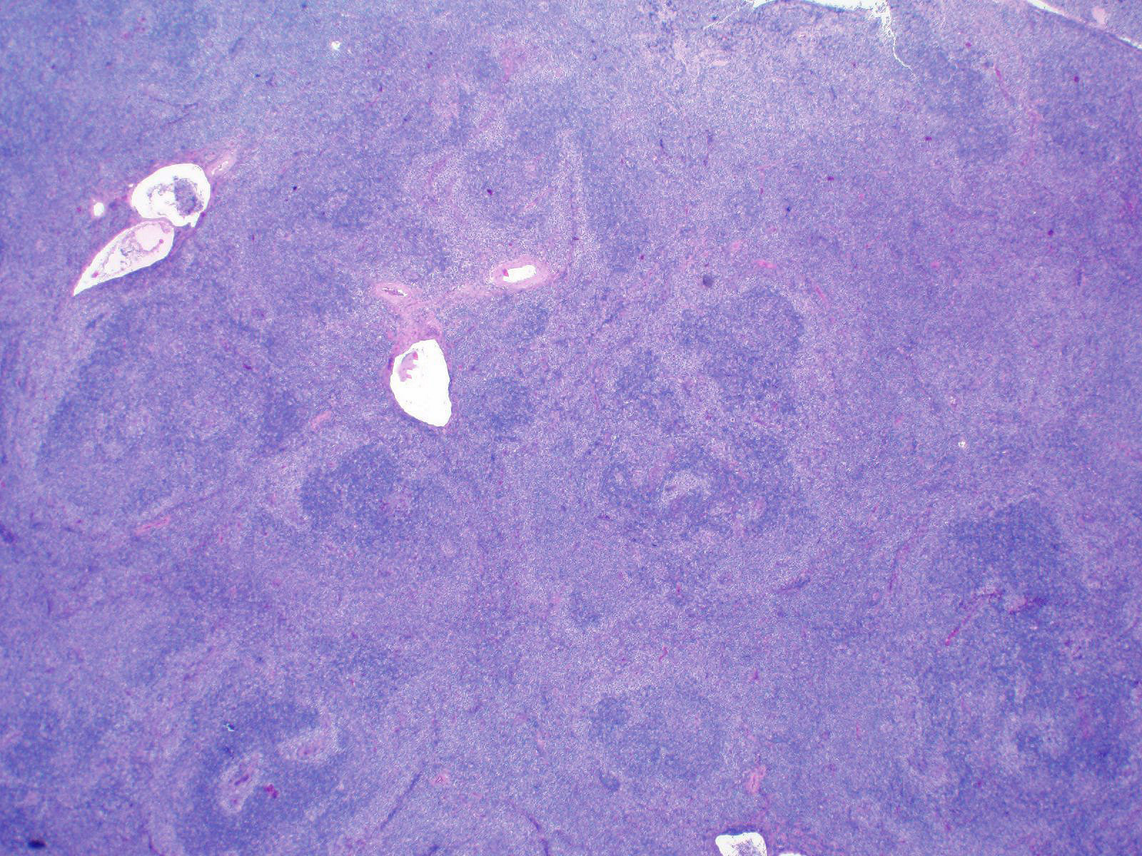 Lymph node with nodal marginal zone lymphoma (NMZL)