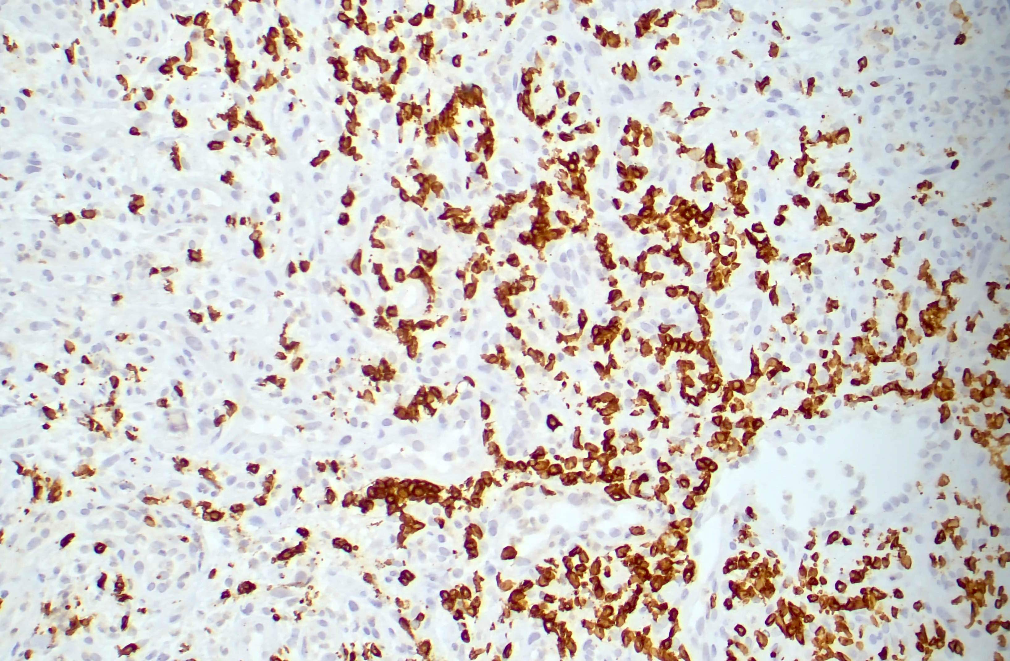 CD3 positive large cells