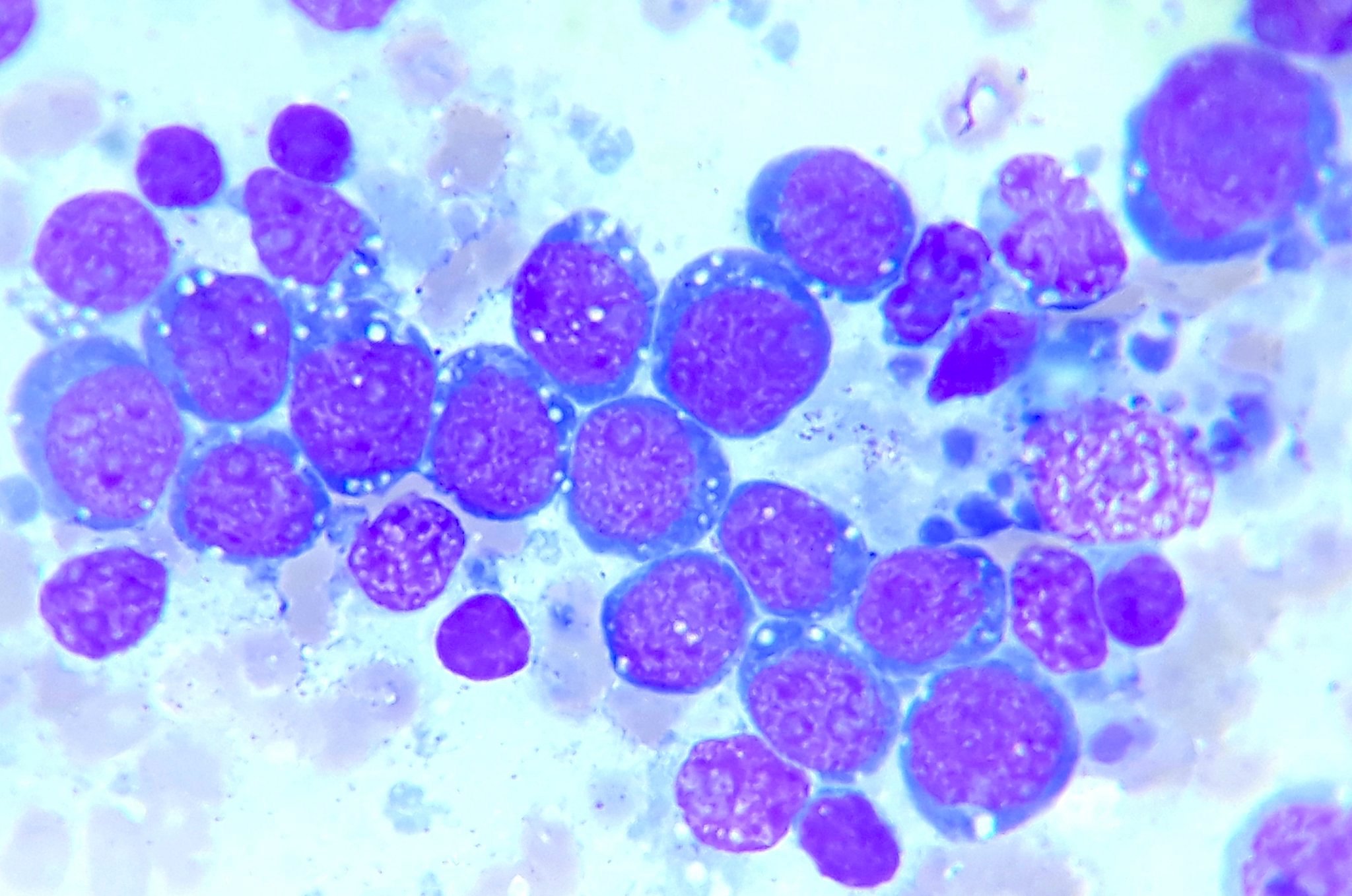 Pathology Outlines - Burkitt lymphoma