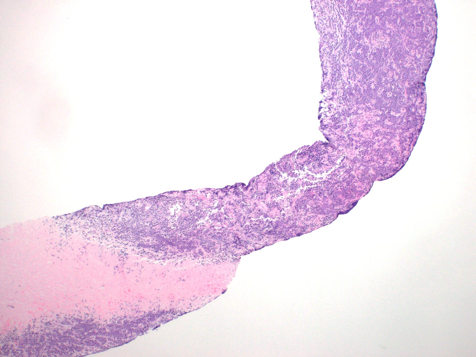 Diffuse lymph node infiltration by lymphoma cells