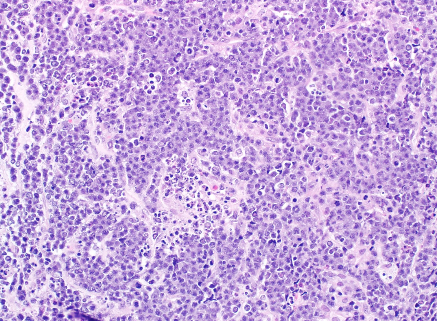 Lymphoma cells with interspersed tingible body macrophages