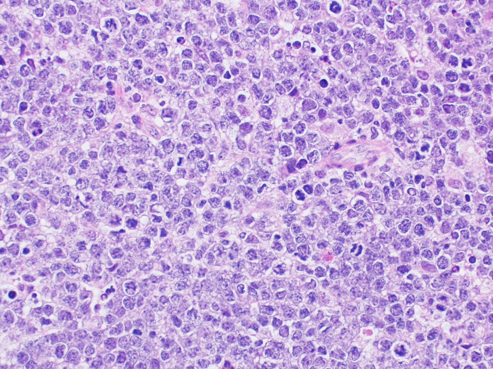 Atypical lymphoma cells