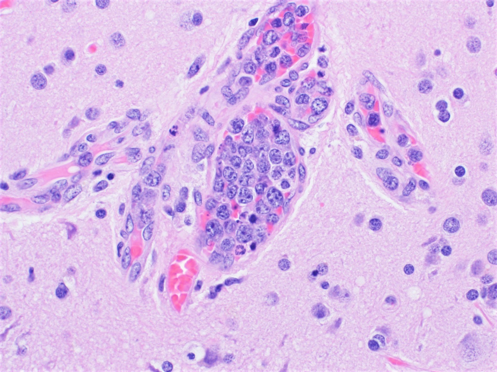 Large lymphoma cells in the vessels