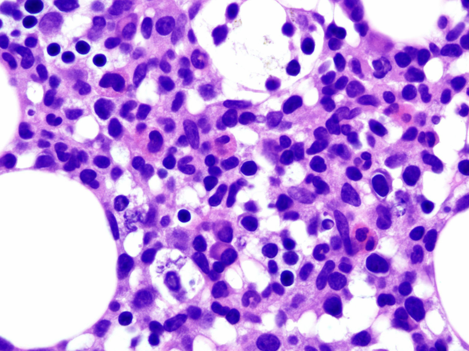  cell LGL leukemia