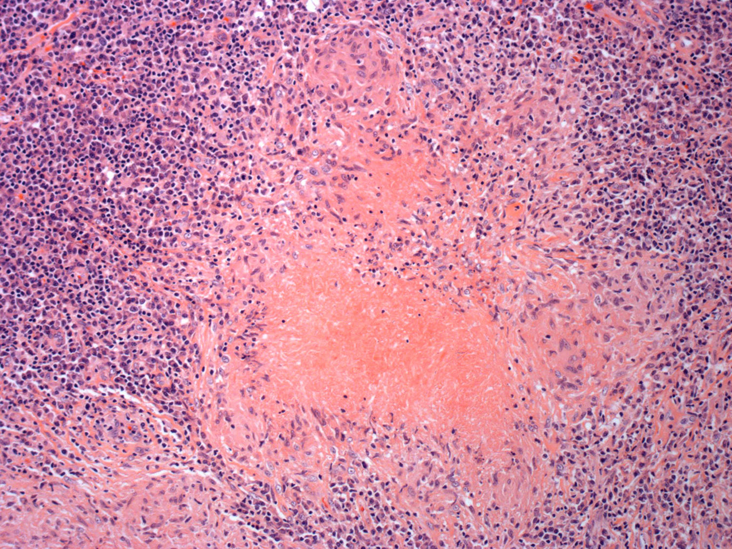 Necrosis in tuberculosis