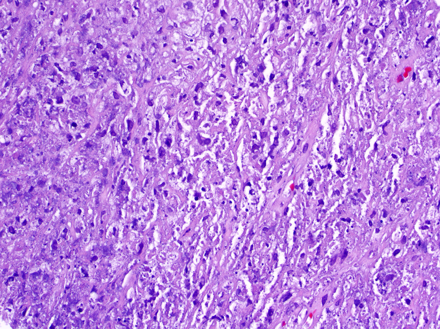 Necrosis in histoplasmosis