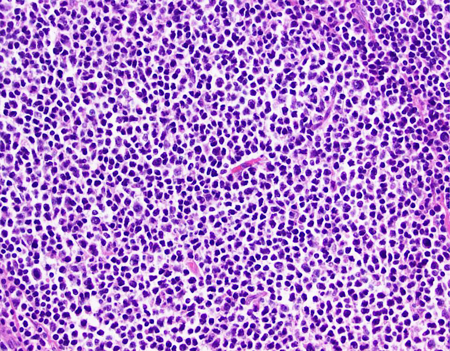 Pathology Outlines Follicular Usual