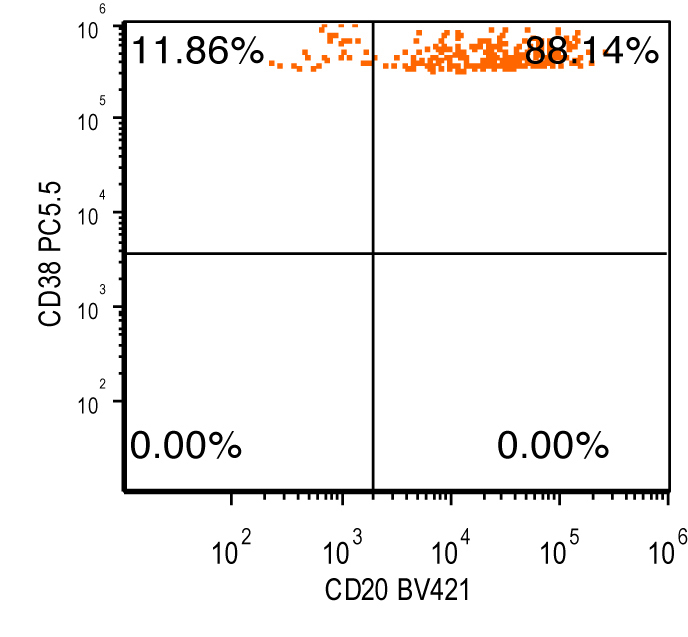Presence of CD20 expression