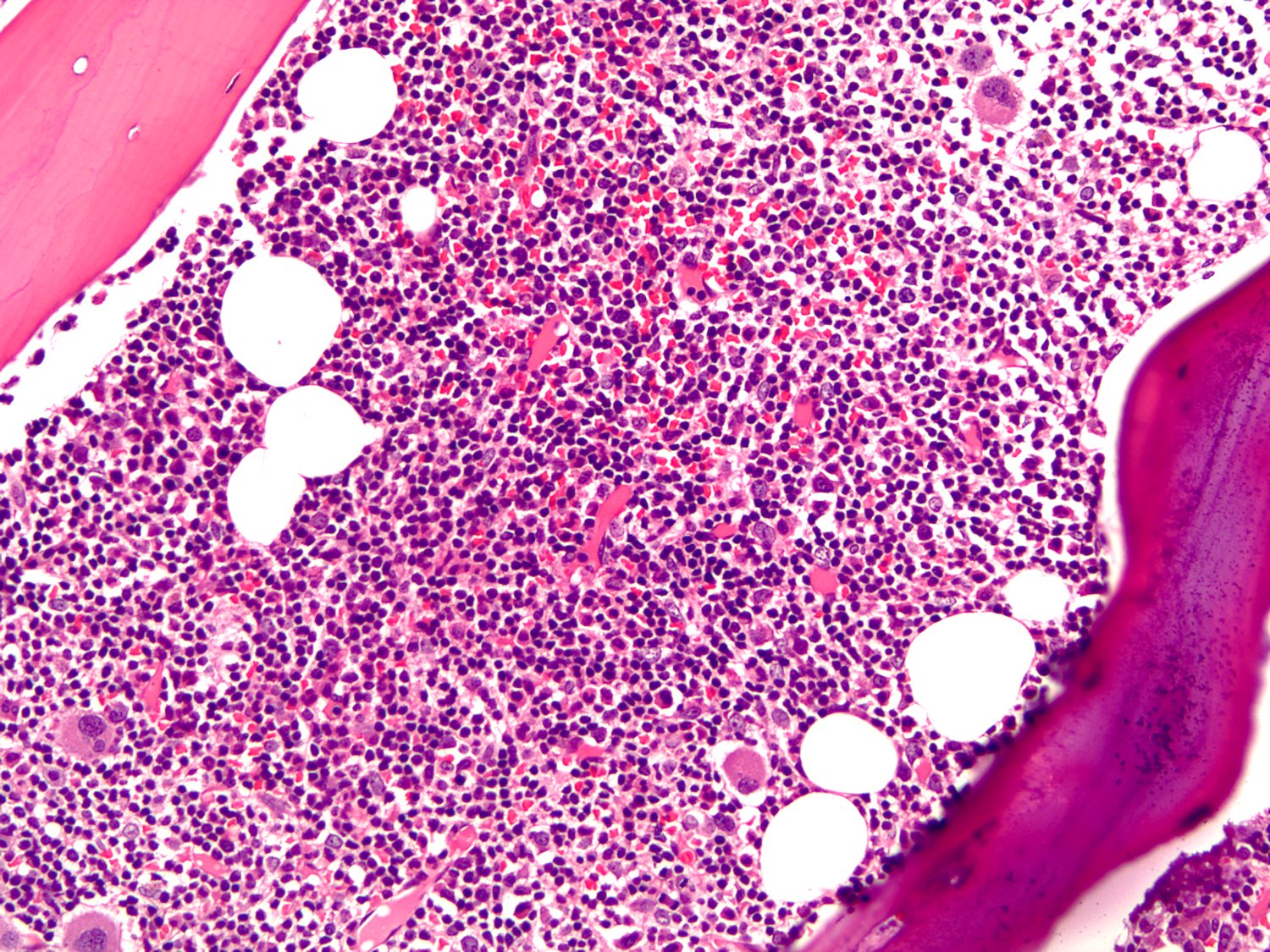 lymphoid papillomatosis pathology outlines