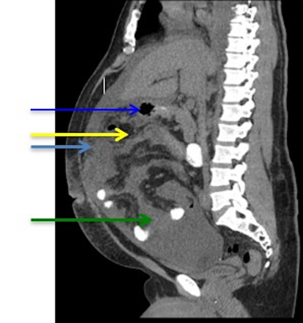CT abdomen and pelvis
