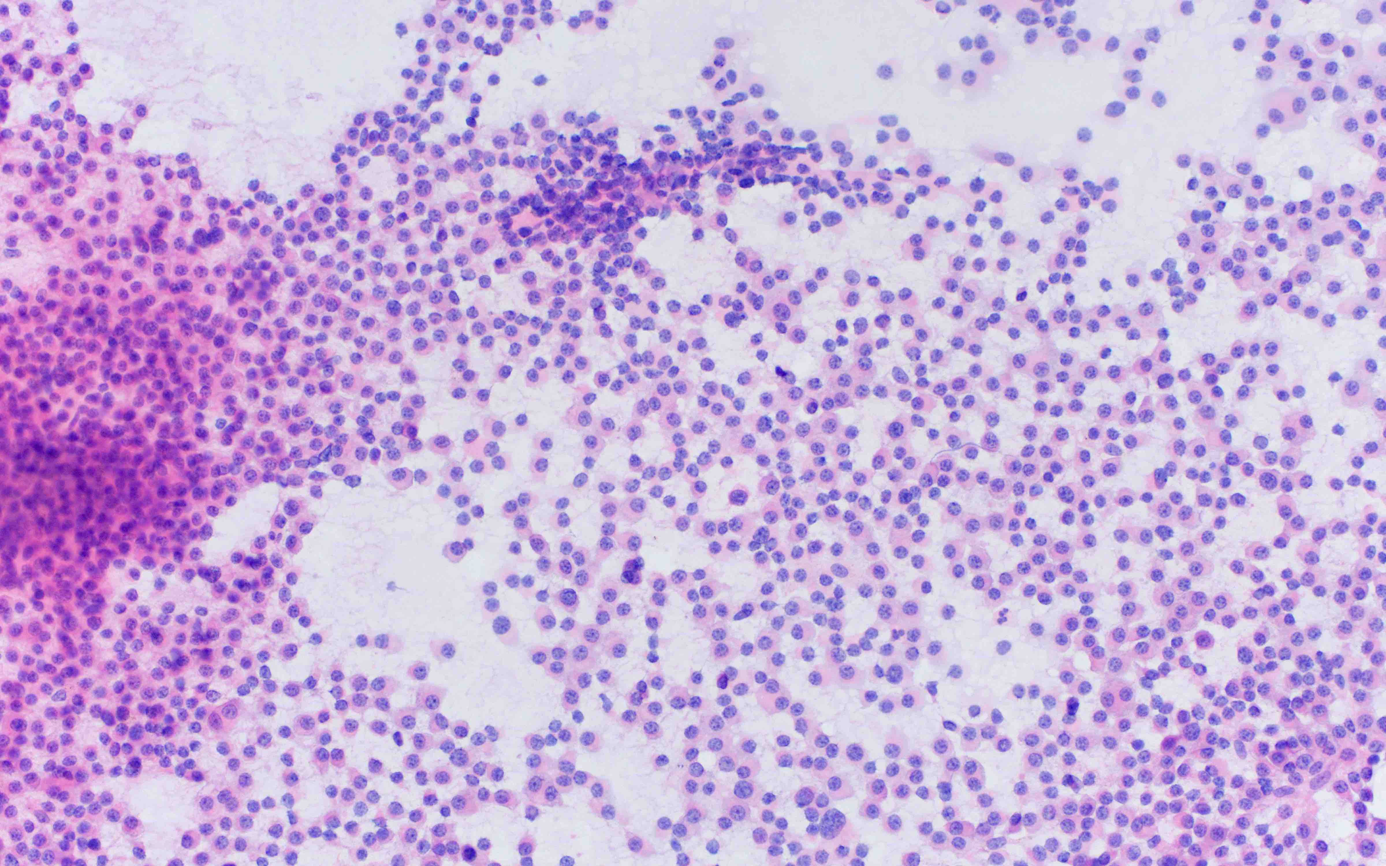 Pathology Outlines - Plasma cell myeloma (multiple myeloma)