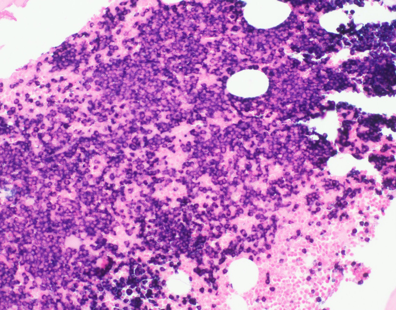 tetraëder Methode Chronisch Pathology Outlines - Plasma cell myeloma (multiple myeloma)