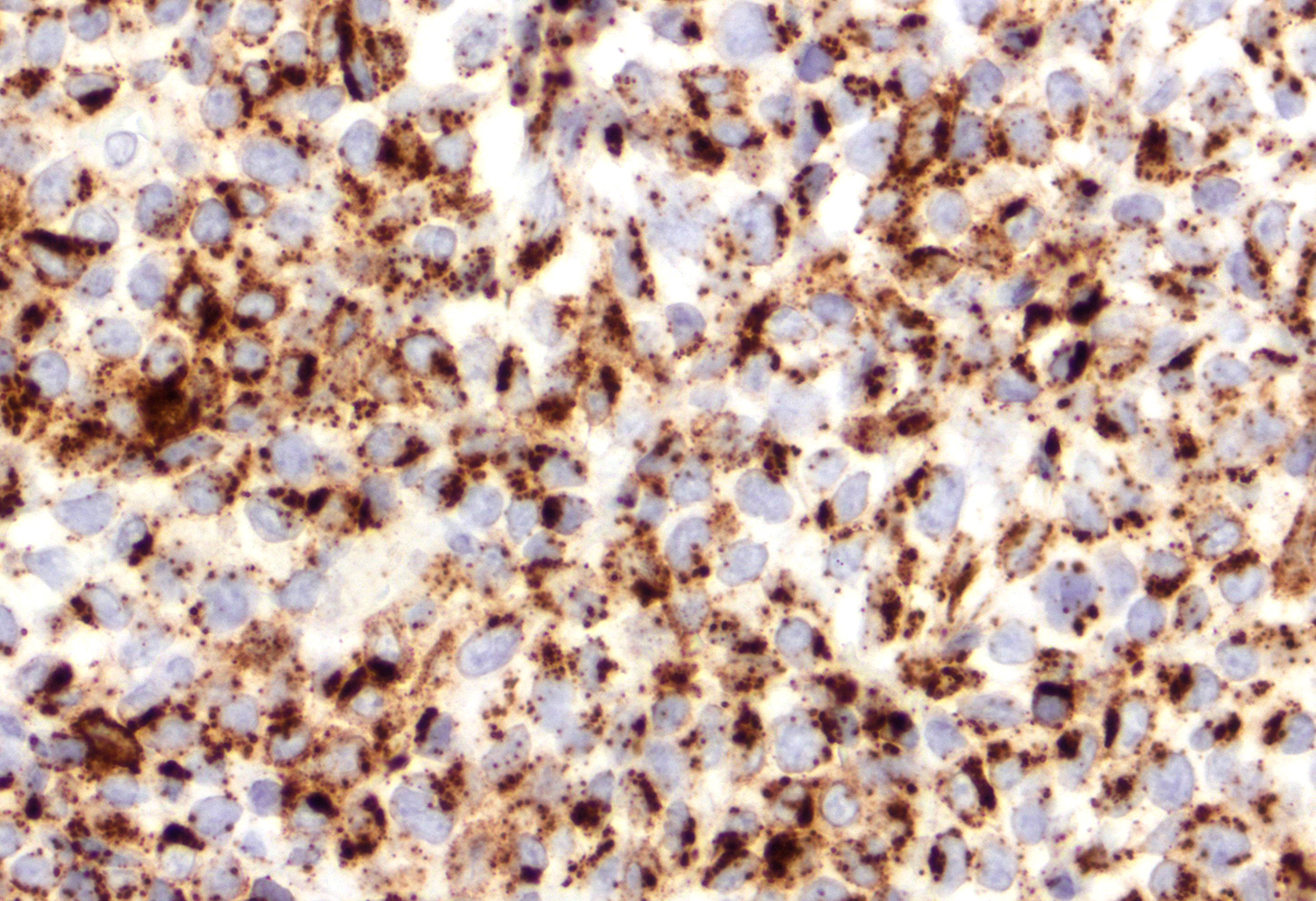 TIA1 positivity of lymphoma cells 