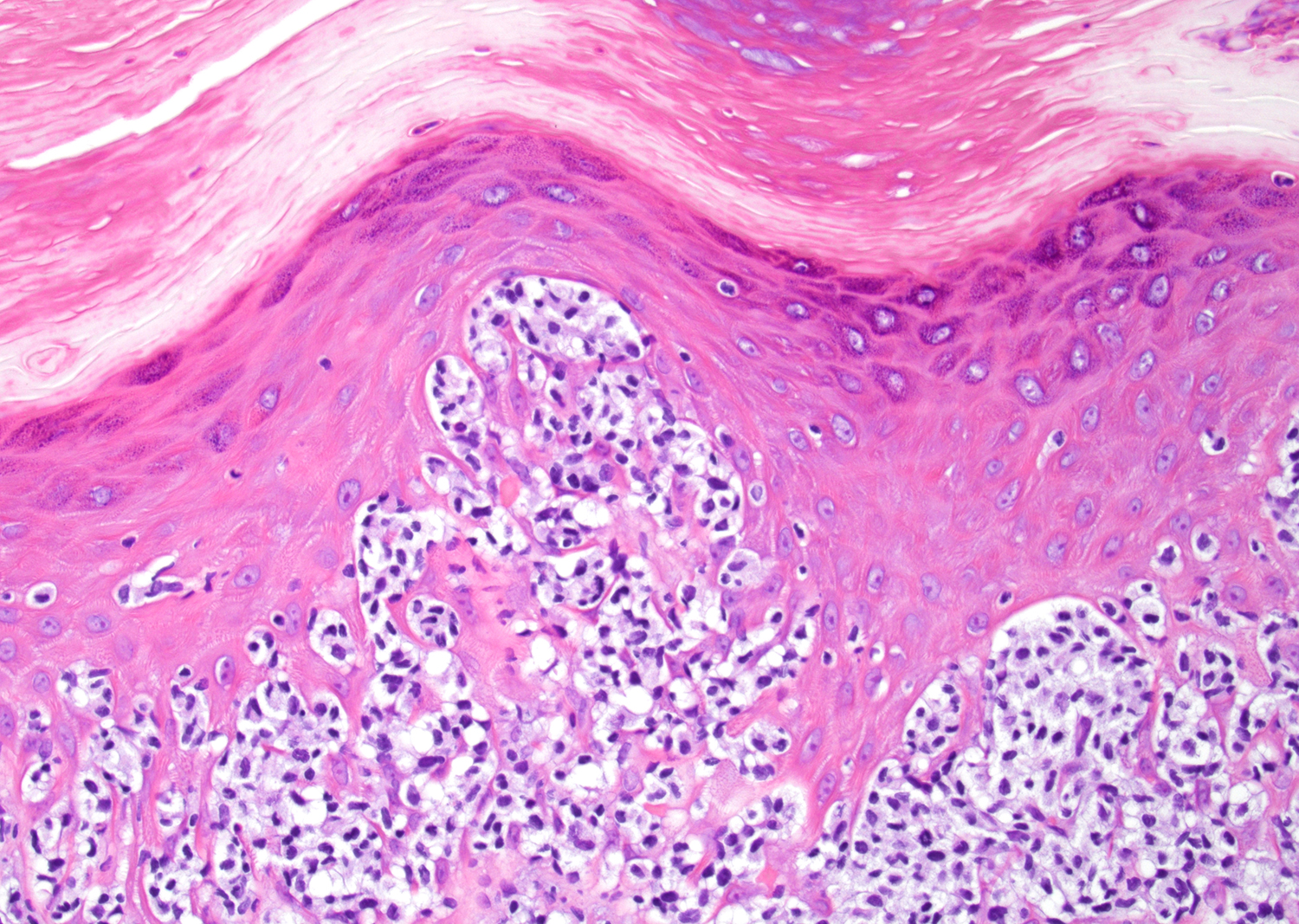 Microabscess of Pautrier in pagetoid reticulosis 