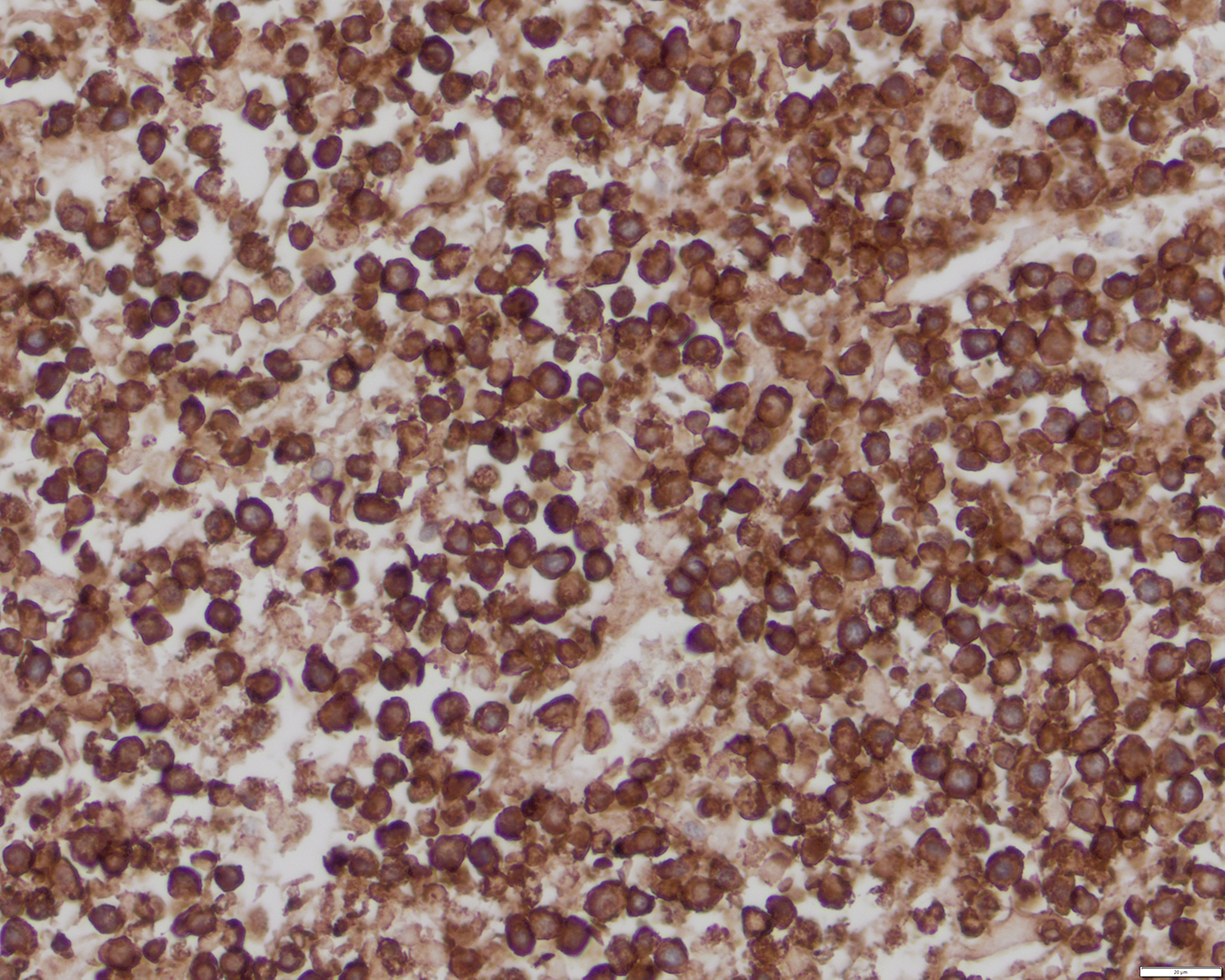 CD3 positive lymphoma cells